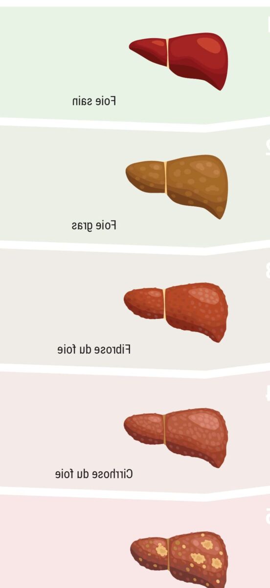 Cancer du foie en phase terminale : un témoignage poignant