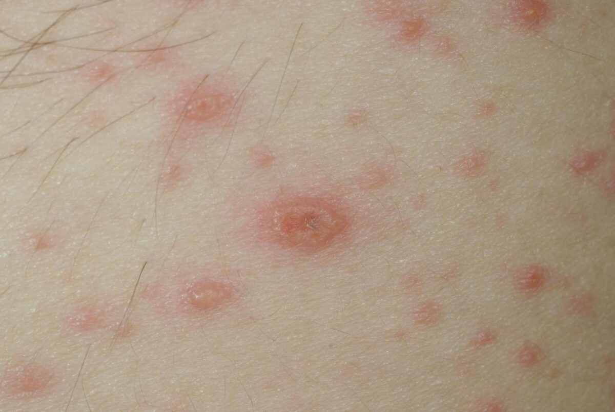 Purpura fulminans : Comprendre et reconnaître les signes du purpura vibice
